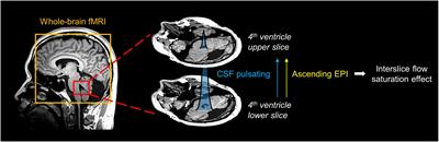 CSF pulsations measured in Parkinson’s disease patients using EPI-based fMRI data